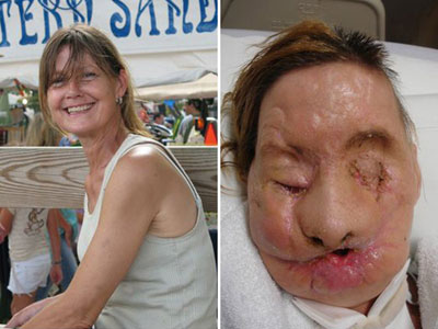 Nova face de mulher desfigurada aps ataque de chimpanz  revelada
