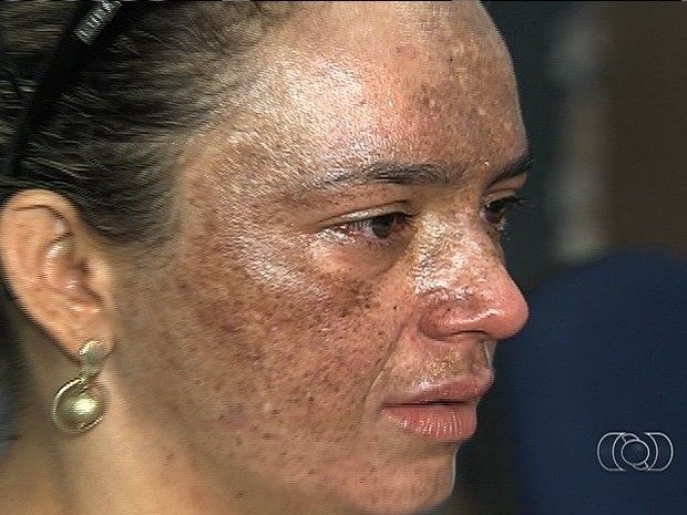 Mulher tem rosto queimado em tratamento e denuncia erro mdico