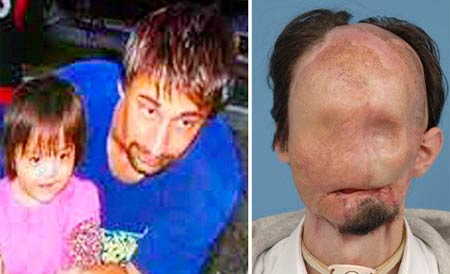 Jovem recebe primeiro transplante total de rosto dos EUA