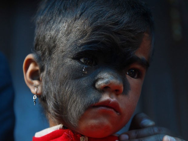 Cirurgia remove mancha peluda do rosto de menina nepalesa