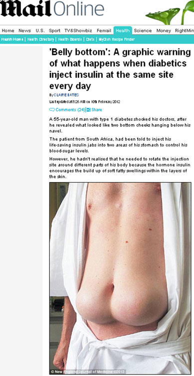 Homem fica com barriga deformada aps injetar insulina no mesmo lugar
