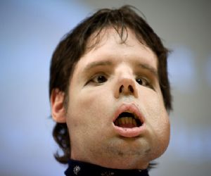 Mdicos mostram paciente que fez transplante total de rosto 