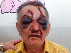 Idoso de 74 anos leva 40 pontos no rosto aps espancamento na Bahia