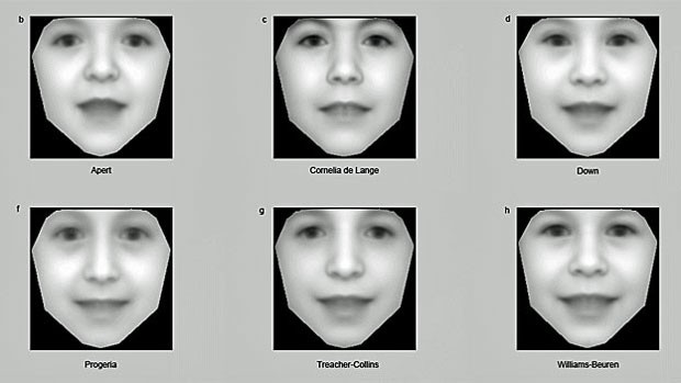 Fotos de expresses faciais podem revelar problemas genticos, diz estudo