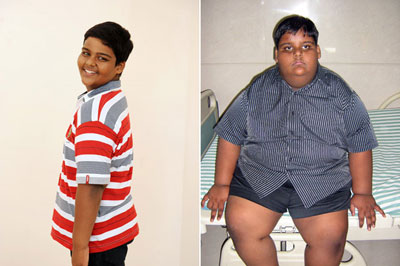 Aos 10 anos, indiano  o mais jovem a fazer cirurgia para reduzir estmago