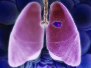 Cncer de pulmo pode se esconder por 20 anos