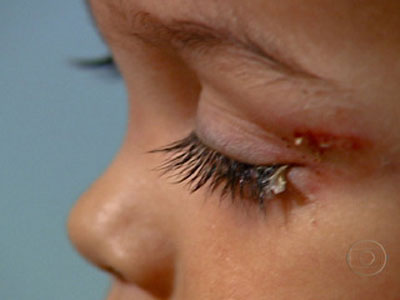 Criana tem o olho colado durante atendimento em hospital no Rio