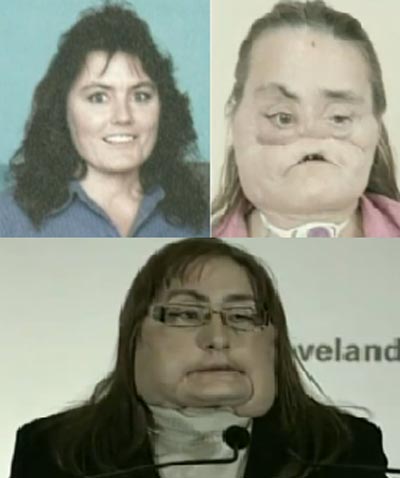 Transplante de rosto Americana Connie Culp, veja as imagens