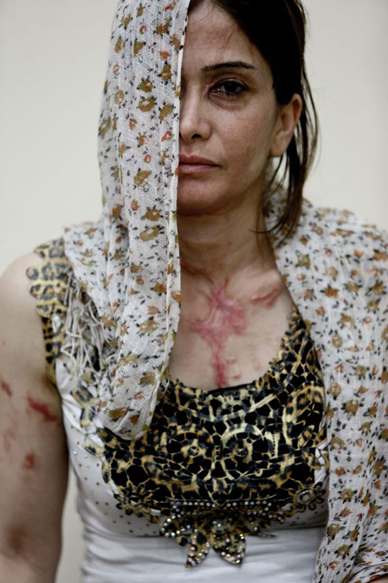 Grvida, mulher atacada com cido na Sria busca tratamento 