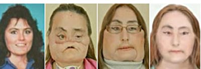 Transplante de rosto Americana Connie Culp, ficar assim
