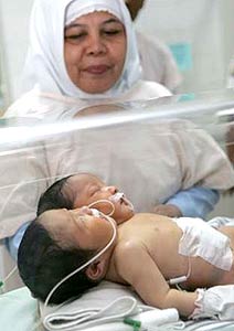 Criana nasce com duas cabeas na Indonsia