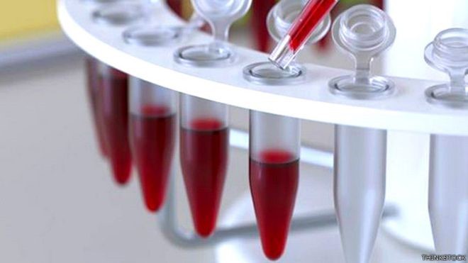 Exame de sangue detecta at 86% de casos precoces