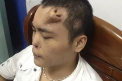 Mdicos chineses implantam nariz na testa de um paciente