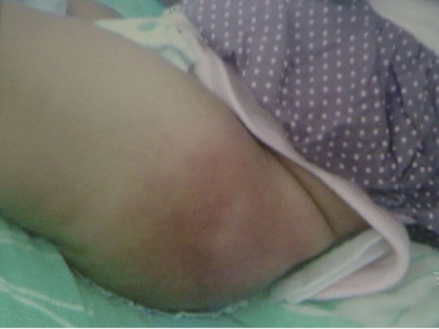 Vacina fica alojada e apodrece em perna de beb no Guaruj, SP
