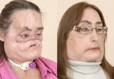 Americana com transplante quase total de rosto exibe o resultado da operao