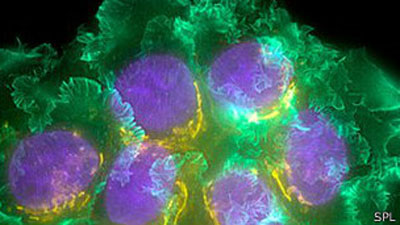  Enzimas liberadas por tumor estimulam ataque ao cncer, diz estudo