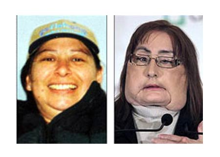Americana que recebeu transplante de rosto encontra famlia de doadora