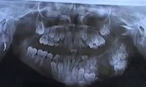 Mdicos removem 80 dentes de mandbula de criana de sete an