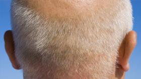 Estudo relaciona perda de cabelo com problemas no corao