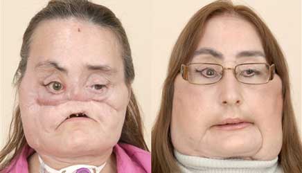 Transplante de rosto traz problemas para a vida toda, mas pa