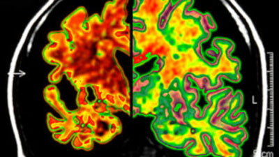 Cientistas criam tcnica para detectar Alzheimer antes de sintomas