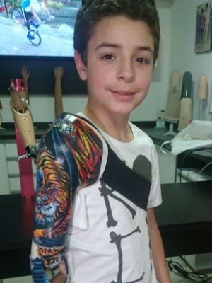 Menino atacado por tigre ganha prtese com desenho personali